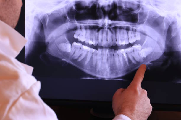 Best Knocked-Out Tooth (Avulsed Tooth) Treatment in Beggs, OK
